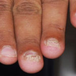His Finger Nails Are Too Short!